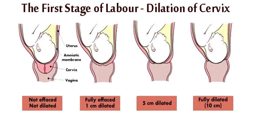 The First Stage of Labour - Dilation of Cervix