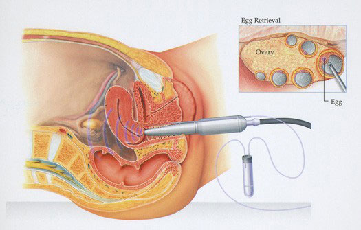 The Egg Retrieval in the IVF Procedure